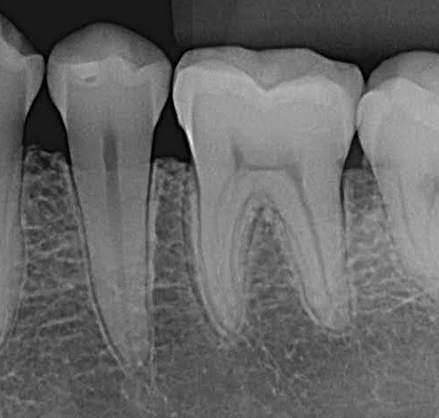 Radiografia periapicais